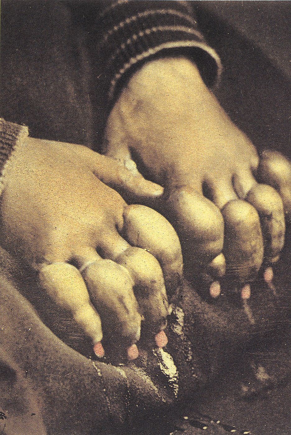 Masterpieces of Medical Photography: Selections from the Burns Archive